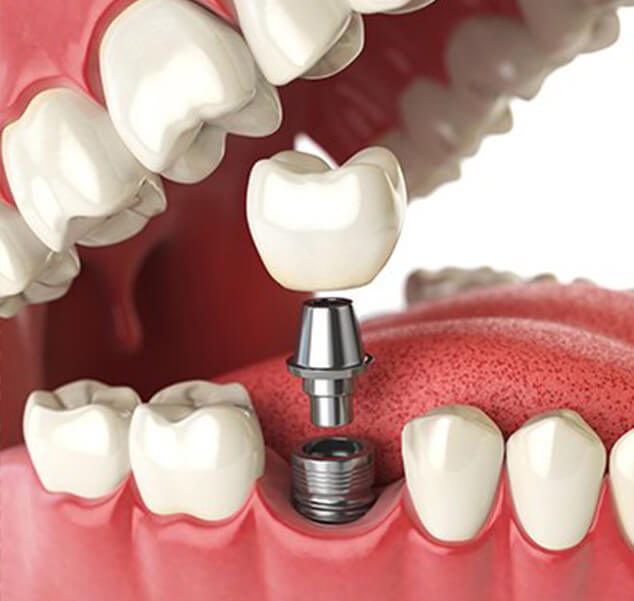 illustration of implant
