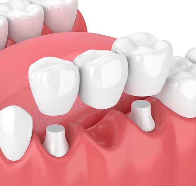 illustration of a dental bridge